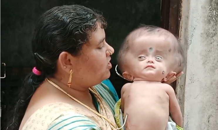 నిర్మల్ జిల్లా ఖానాపూర్‌లో 18 నెలల పాపకు హైడ్రో సిఫాలస్ వ్యాధితో బాధపడుతున్న దంపతులు ప్రభుత్వ సహాయం కోసం వేడుకుంటున్నారు.