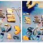 A tragic incident in Hathras, Uttar Pradesh, where a 15-year-old boy, Aditya, passed away after an operation revealed 56 foreign objects in his stomach. Despite medical efforts, he could not be saved.