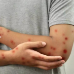 A 40-year-old man from Udupi district tested positive for monkeypox after returning from Dubai. Karnataka health officials confirmed the case.