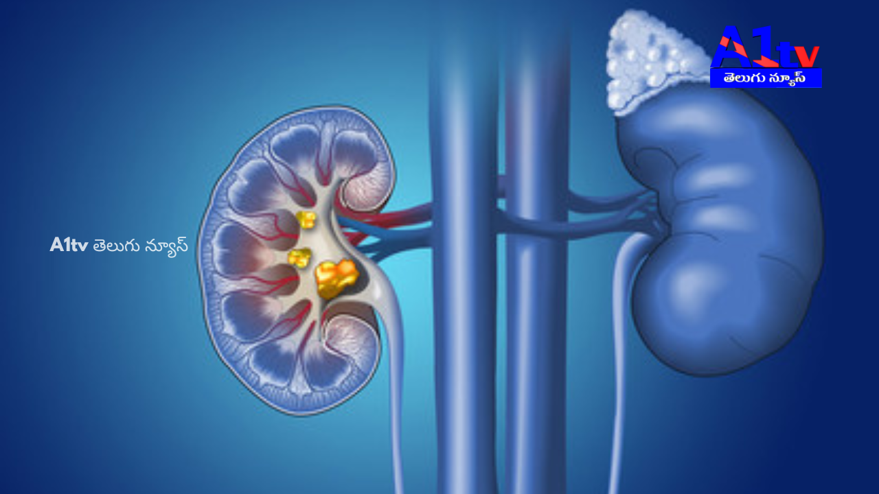 Learn about the foods and habits that can increase the risk of kidney stones, as advised by health experts.