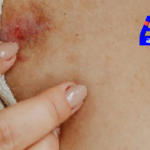 High cholesterol can cause skin changes. Identifying these early signs can help prevent severe health issues.