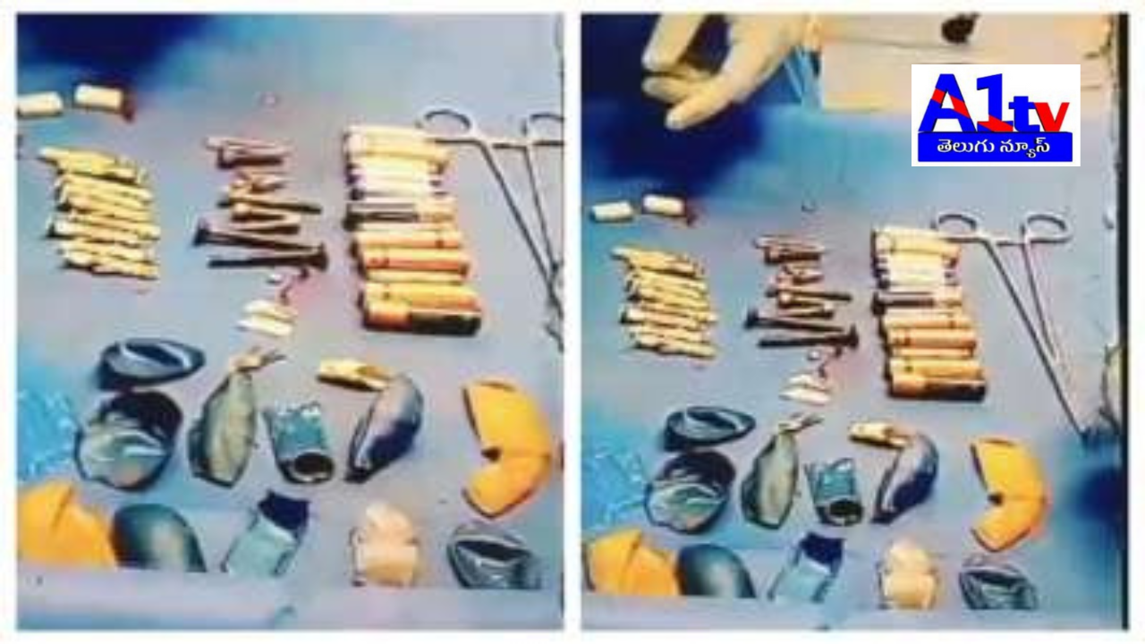 A tragic incident in Hathras, Uttar Pradesh, where a 15-year-old boy, Aditya, passed away after an operation revealed 56 foreign objects in his stomach. Despite medical efforts, he could not be saved.