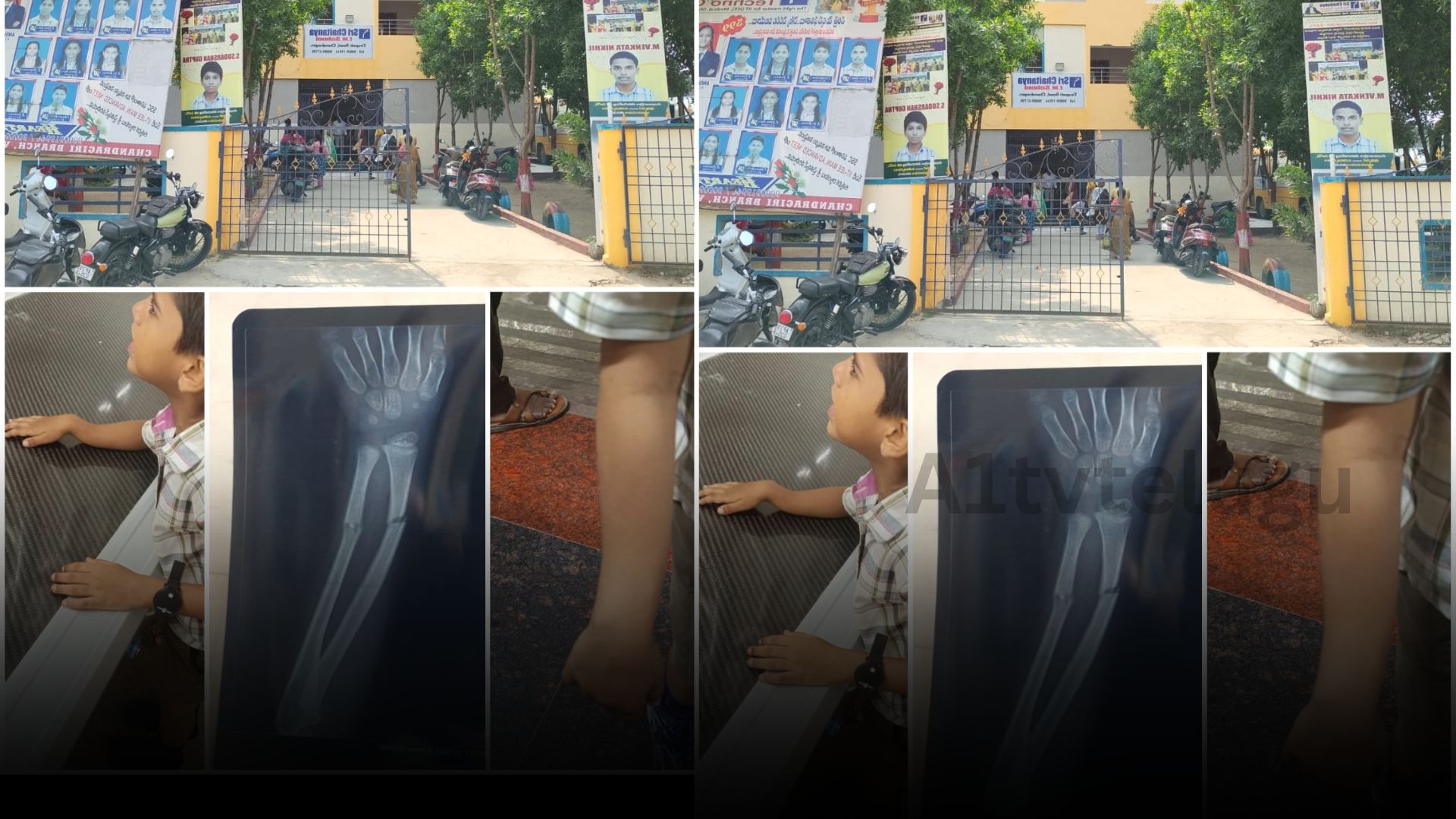 Parents allege negligence after student injured at Chandragiri Chaitanya Techno School