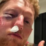 Ben Stokes injury